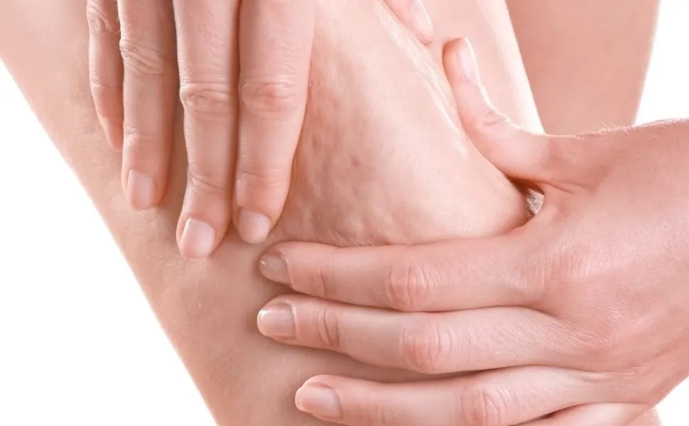 Prof. Dr. Karacalar'dan selülit uyarısı: Portakal kabuğu görüntüsü basit sorun değil!